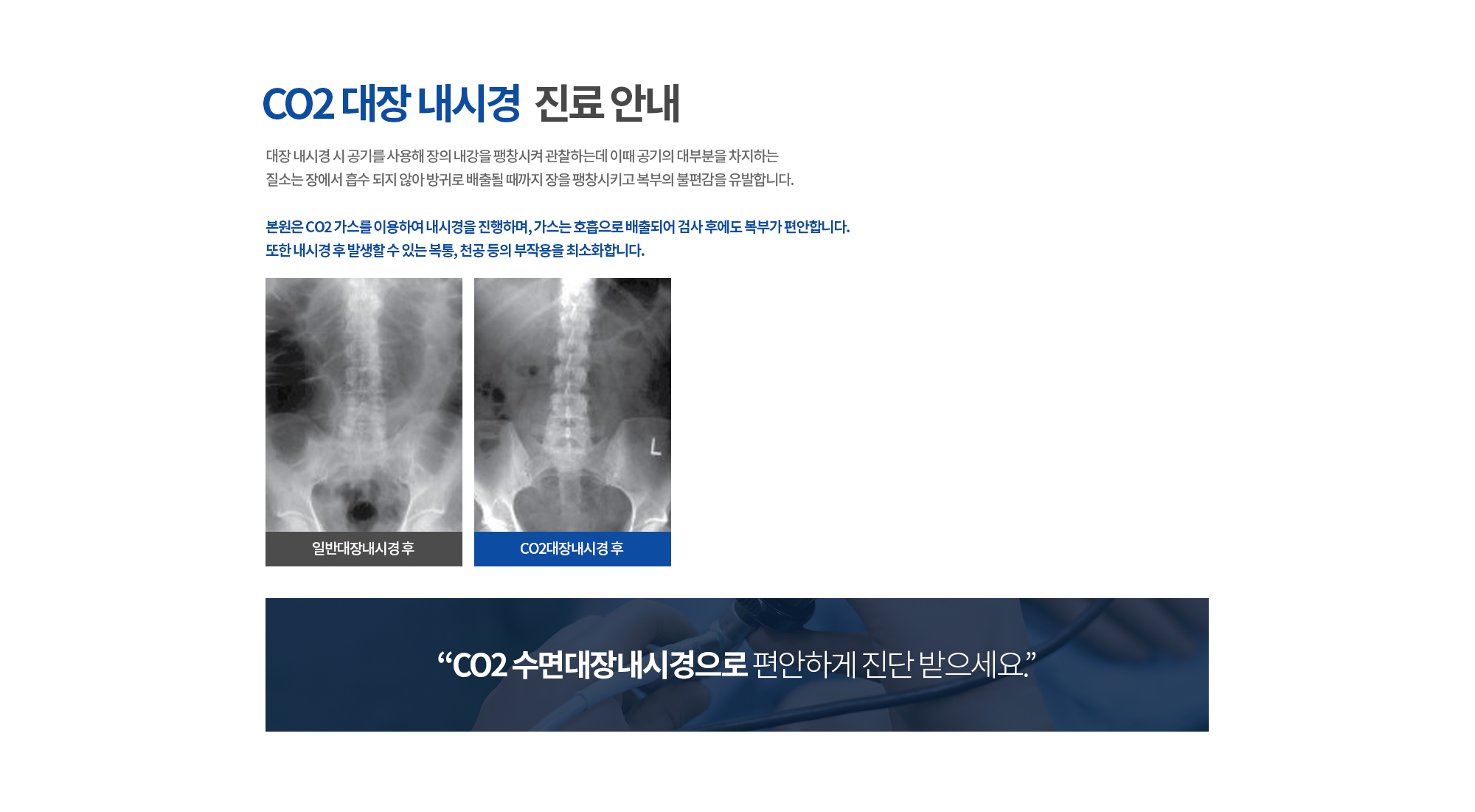 CO2 수면대장내시경으로 편안하게 진단 받으세요.
		CO2 대장 내시경 진료 안내
		대장 내시경 시 공기를 사용해 장의 내강을 팽창시켜 관찰하는데 
		이때 공기의 대부분을 차지하는 질소는 장에서 흡수 되지 않아 방귀로 배출될 때까지
		장을 팽창시키고 복부의 불편감을 유발합니다. 

		본원은 CO2 가스를 이용하여 내시경을 진행하며, 가스는 호흡으로 
		배출되어 검사 후에도 복부가 편안합니다. 

		또한 내시경 후 발생할 수 있는 복통, 천공 등의 부작용을 최소화합니다.